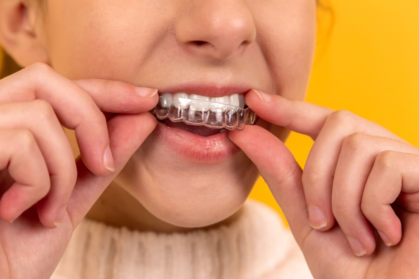 Close detail of a fitted clear dental aligner